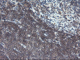 IHC of paraffin-embedded Human lymphoma tissue using anti-TPD52L3 mouse monoclonal antibody.
