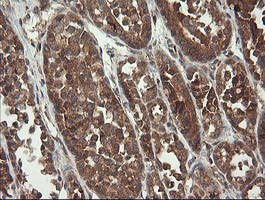 IHC of paraffin-embedded Carcinoma of Human thyroid tissue using anti-TPD52L3 mouse monoclonal antibody.