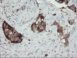 IHC of paraffin-embedded Adenocarcinoma of Human breast tissue using anti-TPD52L3 mouse monoclonal antibody.