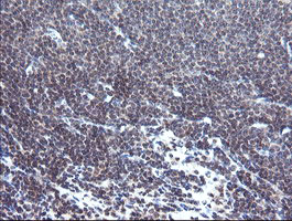 IHC of paraffin-embedded Human lymphoma tissue using anti-TPD52L3 mouse monoclonal antibody. (Heat-induced epitope retrieval by 10mM citric buffer, pH6.0, 120°C for 3min).