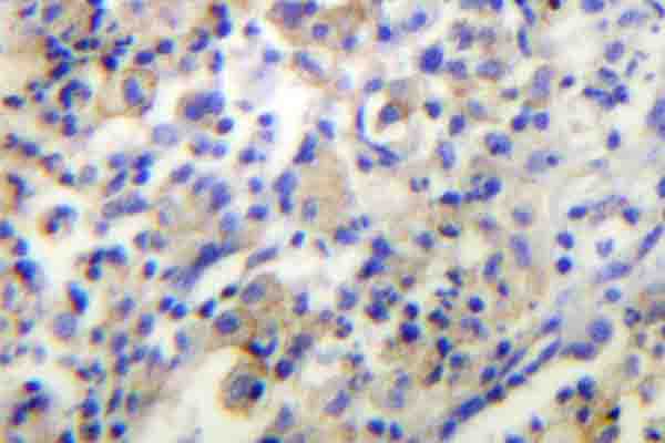 IHC of TPH1 (V256) pAb in paraffin-embedded human lung carcinoma tissue.