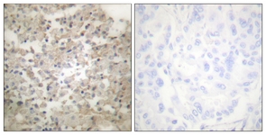 IHC of paraffin-embedded human lung carcinoma, using Tryptophan Hydroxylase (Phospho-Ser260) Antibody. The sample on the right was incubated with synthetic peptide.