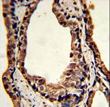 Formalin-fixed and paraffin-embedded human prostate carcinoma reacted with TPI1 Antibody , which was peroxidase-conjugated to the secondary antibody, followed by DAB staining. This data demonstrates the use of this antibody for immunohistochemistry; clinical relevance has not been evaluated.