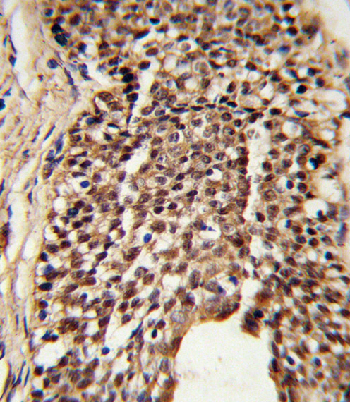 Formalin-fixed and paraffin-embedded human prostate carcinoma reacted with TPI1 Antibody , which was peroxidase-conjugated to the secondary antibody, followed by DAB staining. This data demonstrates the use of this antibody for immunohistochemistry; clinical relevance has not been evaluated.