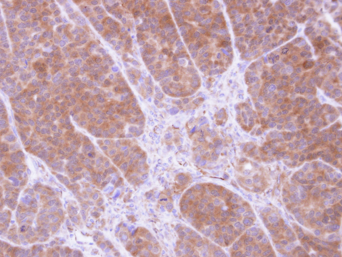 IHC of paraffin-embedded SW480 xenograft using Tropomyosin 2 antibody at 1:100 dilution.