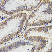 Immunohistochemistry of paraffin-embedded human rectal cancer tissue using TPM2 antibody at dilution of 1:200 (x400 lens)