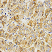 Immunohistochemistry of paraffin-embedded human liver cancer tissue using TPM2 antibody at dilution of 1:200 (x400 lens).