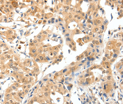 Immunohistochemistry of paraffin-embedded human lung cancer tissue using TPM2 antibody.