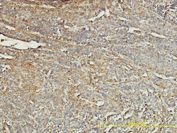 Immunoperoxidase of monoclonal antibody to TPM4 on formalin-fixed paraffin-embedded human transitional cell carcinoma tissue. [antibody concentration 2 ug/ml].