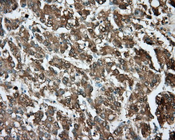 IHC of paraffin-embedded Carcinoma of liver tissue using anti-TPMT mouse monoclonal antibody. (Dilution 1:50).