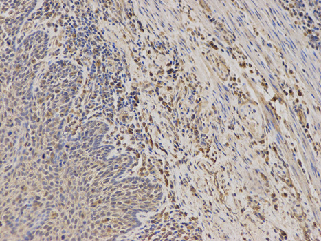 Immunohistochemistry of paraffin-embedded human esophageal cancer using TPMT antibody at dilution of 1:100 (200x lens).