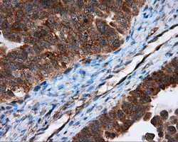 IHC of paraffin-embedded Adenocarcinoma of ovary tissue using anti-TPMT mouse monoclonal antibody. (Dilution 1:50).