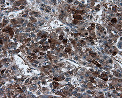 IHC of paraffin-embedded Carcinoma of liver tissue using anti-TPMT mouse monoclonal antibody. (Dilution 1:50).