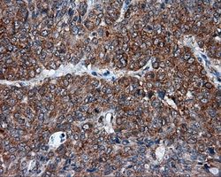 IHC of paraffin-embedded Adenocarcinoma of endometrium tissue using anti-TPMT mouse monoclonal antibody. (Dilution 1:50).