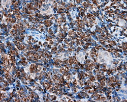 IHC of paraffin-embedded Carcinoma of thyroid tissue using anti-TPMT mouse monoclonal antibody. (Dilution 1:50).