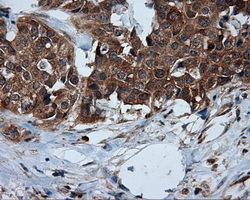IHC of paraffin-embedded Adenocarcinoma of breast tissue using anti-TPMT mouse monoclonal antibody. (Dilution 1:50).