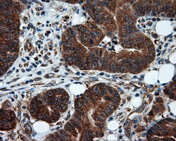 IHC of paraffin-embedded Adenocarcinoma of colon tissue using anti-TPMT mouse monoclonal antibody. (Dilution 1:50).