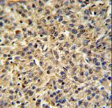TPRGL Antibody IHC of formalin-fixed and paraffin-embedded human cervix carcinoma tissue followed by peroxidase-conjugated secondary antibody and DAB staining.