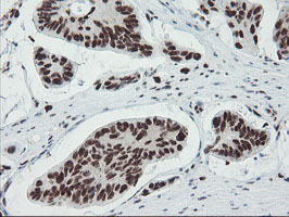 IHC of paraffin-embedded Carcinoma of Human pancreas tissue using anti-TPRKB mouse monoclonal antibody.