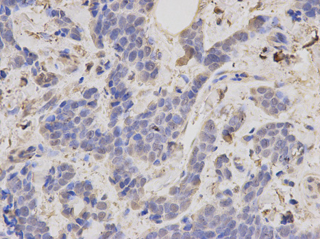 Immunohistochemistry of paraffin-embedded human breast cancer using TRAF6 antibody at dilution of 1:200 (400x lens).