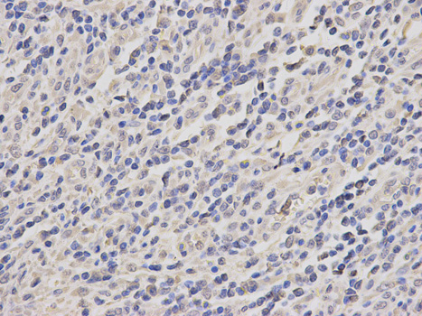 Immunohistochemistry of paraffin-embedded human stomach cancer using TRAF6 antibody at dilution of 1:200 (400x lens).