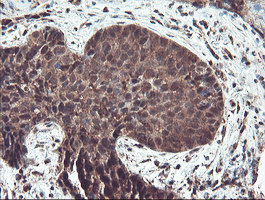 IHC of paraffin-embedded Carcinoma of Human lung tissue using anti-TRAIP mouse monoclonal antibody. (Heat-induced epitope retrieval by 10mM citric buffer, pH6.0, 100C for 10min).