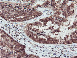 IHC of paraffin-embedded Adenocarcinoma of Human ovary tissue using anti-TRAIP mouse monoclonal antibody. (Heat-induced epitope retrieval by 10mM citric buffer, pH6.0, 100C for 10min).