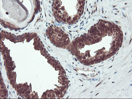 IHC of paraffin-embedded Carcinoma of Human prostate tissue using anti-TRAIP mouse monoclonal antibody. (Heat-induced epitope retrieval by 10mM citric buffer, pH6.0, 100C for 10min).