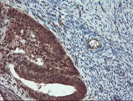 IHC of paraffin-embedded Adenocarcinoma of Human endometrium tissue using anti-TRAIP mouse monoclonal antibody. (Heat-induced epitope retrieval by 10mM citric buffer, pH6.0, 100C for 10min).