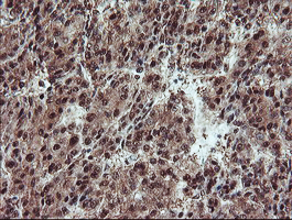 IHC of paraffin-embedded Carcinoma of Human liver tissue using anti-TRAIP mouse monoclonal antibody. (Heat-induced epitope retrieval by 10mM citric buffer, pH6.0, 100C for 10min).