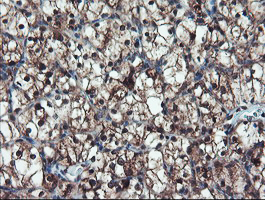IHC of paraffin-embedded Carcinoma of Human kidney tissue using anti-TRAIP mouse monoclonal antibody. (Heat-induced epitope retrieval by 10mM citric buffer, pH6.0, 100C for 10min).