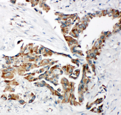 TRAM1 antibody. IHC(P): Human Lung Cancer Tissue.