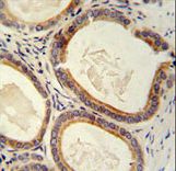 TRAM2 antibody immunohistochemistry of formalin-fixed and paraffin-embedded human prostate carcinoma followed by peroxidase-conjugated secondary antibody and DAB staining.