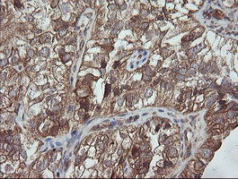 IHC of paraffin-embedded Adenocarcinoma of Human ovary tissue using anti-TRAPPC4 mouse monoclonal antibody.