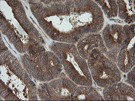 IHC of paraffin-embedded Adenocarcinoma of Human endometrium tissue using anti-TRAPPC4 mouse monoclonal antibody.