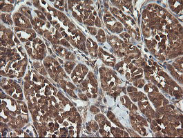 IHC of paraffin-embedded Carcinoma of Human thyroid tissue using anti-TRAPPC4 mouse monoclonal antibody.