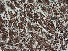 IHC of paraffin-embedded Carcinoma of Human liver tissue using anti-TRAPPC4 mouse monoclonal antibody.