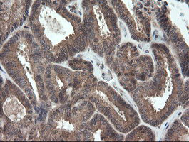 IHC of paraffin-embedded Adenocarcinoma of Human endometrium tissue using anti-TRAPPC4 mouse monoclonal antibody.