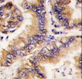 Formalin-fixed and paraffin-embedded human lung carcinoma tissue reacted with TRAPPC4 antibody , which was peroxidase-conjugated to the secondary antibody, followed by DAB staining. This data demonstrates the use of this antibody for immunohistochemistry; clinical relevance has not been evaluated.