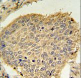 TPC6A Antibody IHC of formalin-fixed and paraffin-embedded human lung carcinoma followed by peroxidase-conjugated secondary antibody and DAB staining.