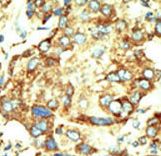 Formalin-fixed and paraffin-embedded human cancer tissue reacted with the primary antibody, which was peroxidase-conjugated to the secondary antibody, followed by DAB staining. This data demonstrates the use of this antibody for immunohistochemistry; clinical relevance has not been evaluated. BC = breast carcinoma; HC = hepatocarcinoma.
