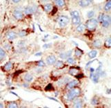 Formalin-fixed and paraffin-embedded human cancer tissue reacted with the primary antibody, which was peroxidase-conjugated to the secondary antibody, followed by DAB staining. This data demonstrates the use of this antibody for immunohistochemistry; clinical relevance has not been evaluated. BC = breast carcinoma; HC = hepatocarcinoma.