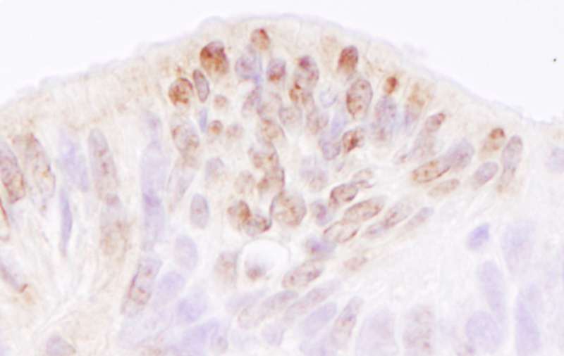 Detection of Human TReP-132/TRERF1 by Immunohistochemistry. Sample: FFPE section of human ovarian carcinoma. Antibody: Affinity purified rabbit anti-TReP-132/TRERF1 used at a dilution of 1:5000 (0.2 ug/ml). Detection: DAB.