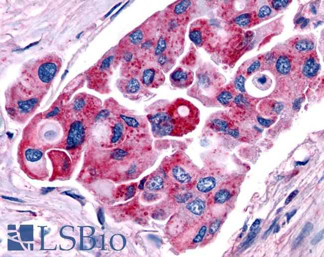 Anti-TRH Receptor / TRHR antibody IHC of human Lung, Non-Small Cell Carcinoma. Immunohistochemistry of formalin-fixed, paraffin-embedded tissue after heat-induced antigen retrieval.
