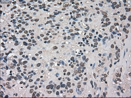 IHC of paraffin-embedded Carcinoma of bladder tissue using anti-TRIB2 mouse monoclonal antibody. (Dilution 1:50).