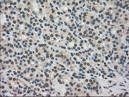 IHC of paraffin-embedded Carcinoma of thyroid tissue using anti-TRIB2 mouse monoclonal antibody. (Dilution 1:50).