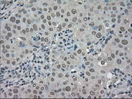 IHC of paraffin-embedded Adenocarcinoma of breast tissue using anti-TRIB2 mouse monoclonal antibody. (Dilution 1:50).