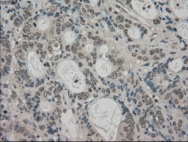 IHC of paraffin-embedded Adenocarcinoma of colon tissue using anti-TRIB2 mouse monoclonal antibody. (Dilution 1:50).