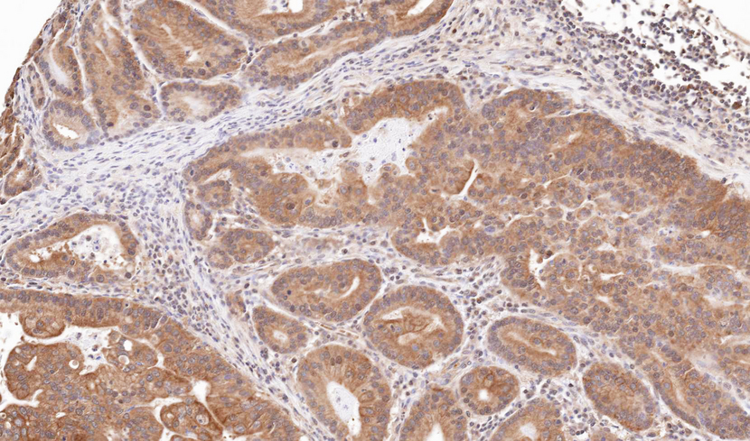 IHC of paraffin-embedded gastric CA using TRIM23 antibody at 1:100 dilution.