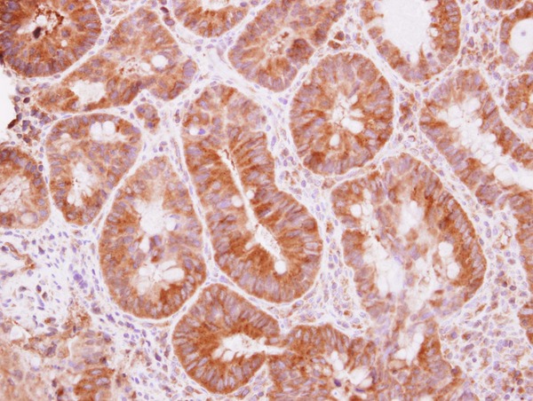 IHC of paraffin-embedded Colon ca, using TRIM25 antibody at 1:500 dilution.